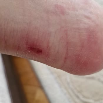 Yüksek Fiyatlı Ayakkabı İlk Giyişte Yara Yaptı