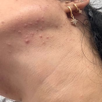 Estee Lauder Serum Sonrası Ani Sivilce Problemi Ve İade Talebi