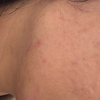 Estee Lauder Serum Sonrası Ani Sivilce Problemi Ve İade Talebi