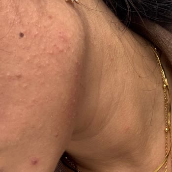 Estee Lauder Serum Sonrası Ani Sivilce Problemi Ve İade Talebi