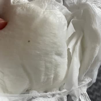 Sleepy Bebek Bezinde Siyah Yabancı Madde Ve Cilt Sorunu