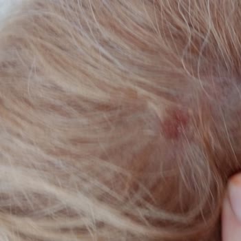 Palette Deluxe Saç Boyası Ciddi Deri Yanmasına Yol Açtı