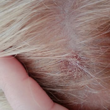 Palette Deluxe Saç Boyası Ciddi Deri Yanmasına Yol Açtı