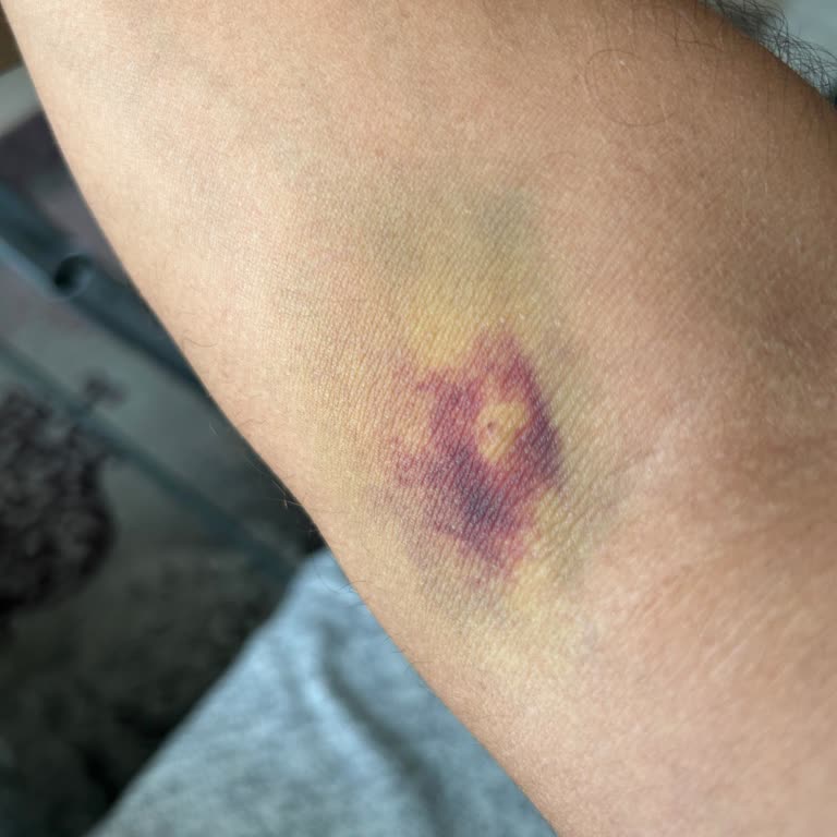 Türk Kızılay Kan Bağışı Sonrası Artan Morarma Hakkında Bilgilendirme Ve Önlem Talebi