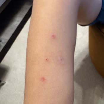 Siveno Losyon Oğlumda Yaralara Sebep Oldu Beklenen Etkiyi Göstermedi