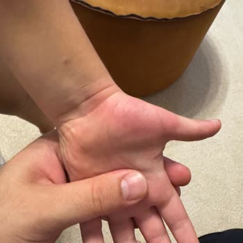 Siveno Losyon Oğlumda Yaralara Sebep Oldu Beklenen Etkiyi Göstermedi