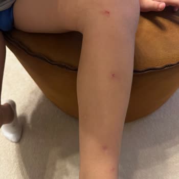 Siveno Losyon Oğlumda Yaralara Sebep Oldu Beklenen Etkiyi Göstermedi