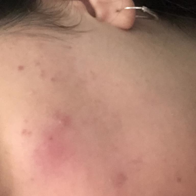 Flormar Kapatıcı Cildimde Sivilce Ve Kaşıntıya Sebep Oldu, Para İadesi Talep Ediyorum