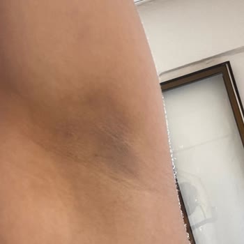 Renk Açma İşleminde Beklenen Sonuç Alınmadı, Ek Seanslar Talep Edildi