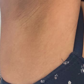 Renk Açma İşleminde Beklenen Sonuç Alınmadı, Ek Seanslar Talep Edildi