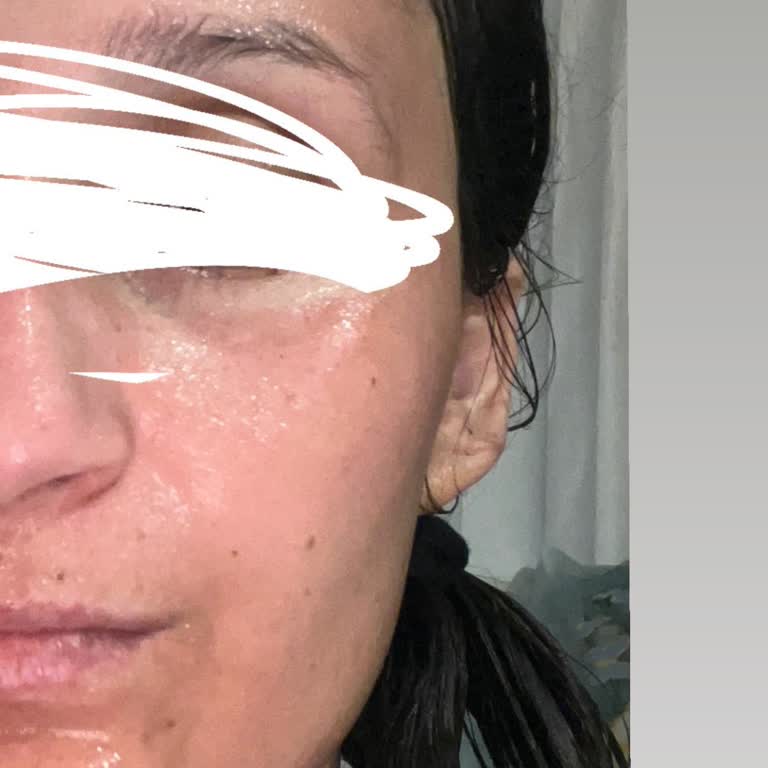 Yves Rocher Pure Algue Peeling Sonrası Yüzümde Ciddi Kızarıklık Ve Yanma Oluştu