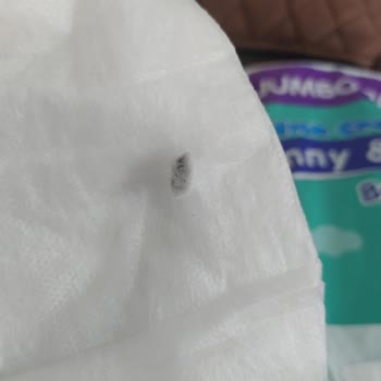 Bebek Bezinden Çıkan Yabancı Madde Ve Alerji Sorunu