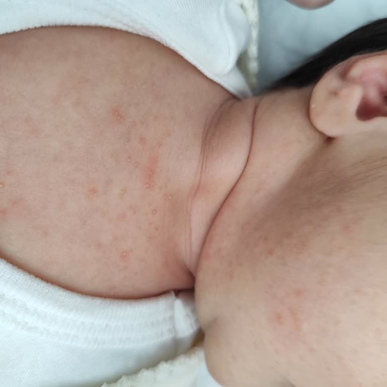 Mustela Şampuan Sonrası Bebekte Ciltte Kızarıklık Ve İltihap Sorunu Yaşadık