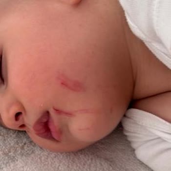 Kaygan Sandalet Çocuğumun Düşmesine Ve Yaralanmasına Neden Oldu