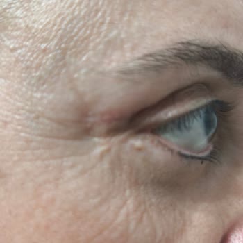 Op. Dr. Erhan Dilek Göz Kapağı Ameliyatı Sonrası Sürekli Rahatsızlık Ve Doktorun İlgisizliği