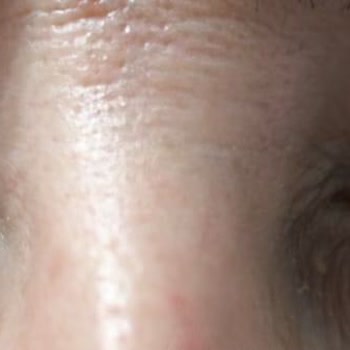 Op. Dr. Erhan Dilek Göz Kapağı Ameliyatı Sonrası Sürekli Rahatsızlık Ve Doktorun İlgisizliği