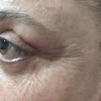 Op. Dr. Erhan Dilek Göz Kapağı Ameliyatı Sonrası Sürekli Rahatsızlık Ve Doktorun İlgisizliği