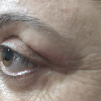 Op. Dr. Erhan Dilek Göz Kapağı Ameliyatı Sonrası Sürekli Rahatsızlık Ve Doktorun İlgisizliği