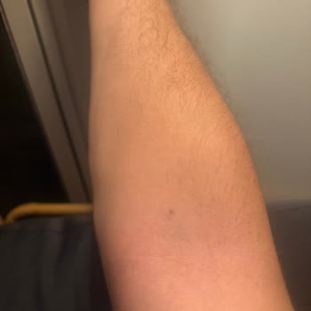 Damar Yolu Açma Sırasında Yaşanan Ağrı Ve İlgisizlik Mağduriyetim