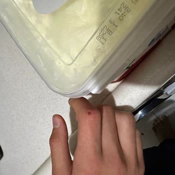 Dost Tava Yoğurt Ambalajı Açılırken Parmak Kesilmesi Ve Tasarım Sorunu