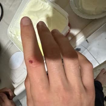 Dost Tava Yoğurt Ambalajı Açılırken Parmak Kesilmesi Ve Tasarım Sorunu