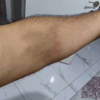 Deneyimsiz Hemşire Nedeniyle Kolumda Morarma Ve Ağrı Oluştu