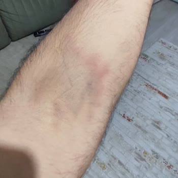 Deneyimsiz Hemşire Nedeniyle Kolumda Morarma Ve Ağrı Oluştu