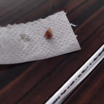 Lezita Kasap Köfte İçinden Kemik Ve Yabancı Parça Çıktı!