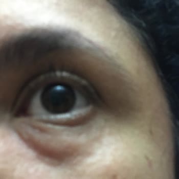 Göz Çevresi Kremi Şiddetli Alerji Yaptı, İade Talebim Cevapsız Kaldı