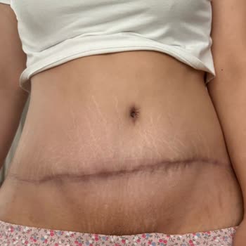 Karın Germe Sonrası Mağduriyet Ve İade Talebim Reddedildi