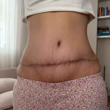 Karın Germe Sonrası Mağduriyet Ve İade Talebim Reddedildi