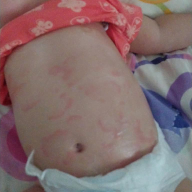 Mustela Göğüs Balsamı Çocuğumda Alerjik Reaksiyona Sebep Oldu