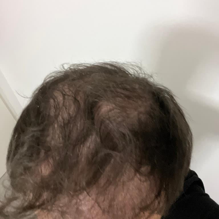 Saç Ekimi Sonrası Mağduriyet Ve Güven Kaybı Yaşadım