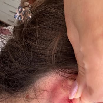 Çelik Diye Satılan Küpe Alerji Ve Yara Yaptı Mağaza Dönüş Yapmıyor