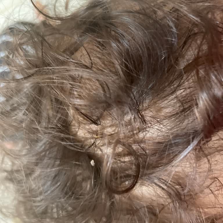 Bebek Şampuanı Sonrası Cilt Sorunu Ve Mağduriyet