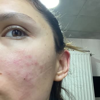 Yves Rocher Ürünleri Cildimde Döküntü Ve Kızarıklık Yaptı İade Süreci Uzatılıyor