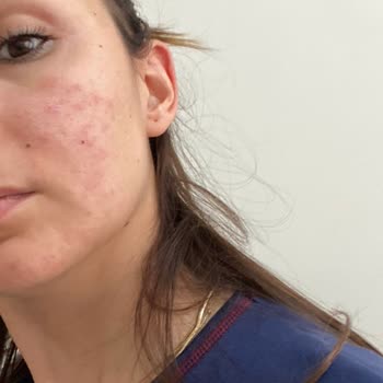 Yves Rocher Ürünleri Cildimde Döküntü Ve Kızarıklık Yaptı İade Süreci Uzatılıyor