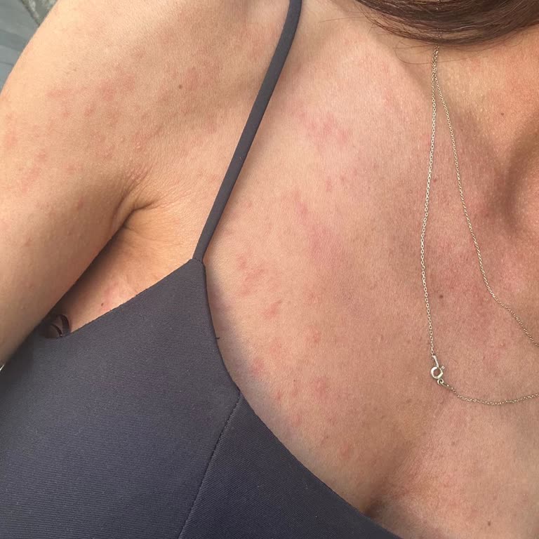 Makbul Fıstık Ezmesi Sonrası Gıda Zehirlenmesi Ve Sağlık Sorunları