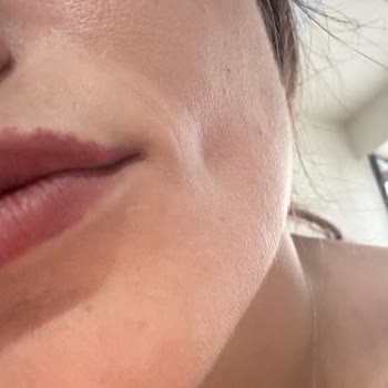 Akne Mezoterapisi Sonrası Kalıcı Yüz Hasarı Ve Destek Eksikliği