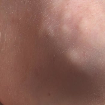 Akne Mezoterapisi Sonrası Kalıcı Yüz Hasarı Ve Destek Eksikliği