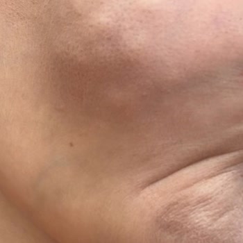 Akne Mezoterapisi Sonrası Kalıcı Yüz Hasarı Ve Destek Eksikliği