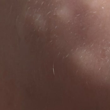 Akne Mezoterapisi Sonrası Kalıcı Yüz Hasarı Ve Destek Eksikliği