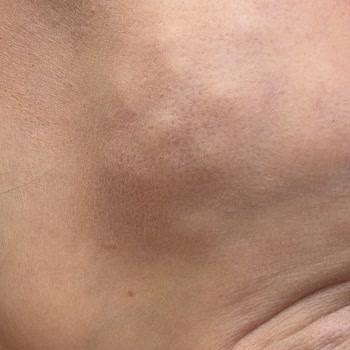 Akne Mezoterapisi Sonrası Kalıcı Yüz Hasarı Ve Destek Eksikliği