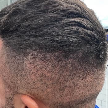 Elithair fehlerhafte Haartransplantation vernarbter Spenderbereich