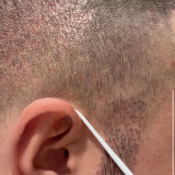Elithair fehlerhafte Haartransplantation vernarbter Spenderbereich