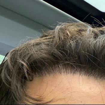 Elithair fehlerhafte Haartransplantation vernarbter Spenderbereich