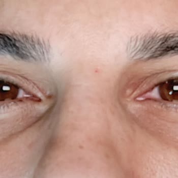 Trendyol Alerjik Reaksiyon Yapan Göz Kremi İçin İade Talebim Reddedildi