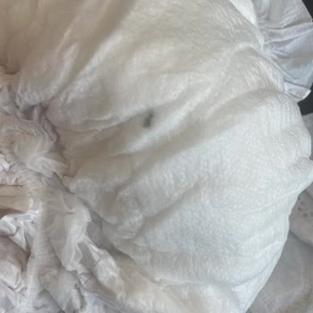 Bebek Bezinde Yabancı Cisim Şoku Ve Pişik Sorunu