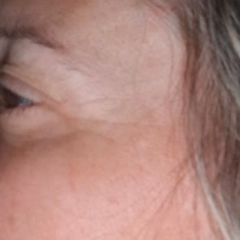 Clinic Allstar Yaptırdığım İşlemlerin Etkisini Görmedim