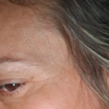 Clinic Allstar Yaptırdığım İşlemlerin Etkisini Görmedim